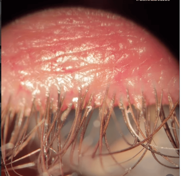 Close up of eye mites